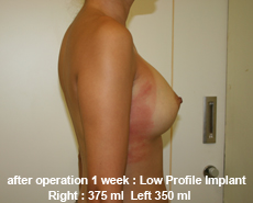 plastic-surgery-breast-augmentation